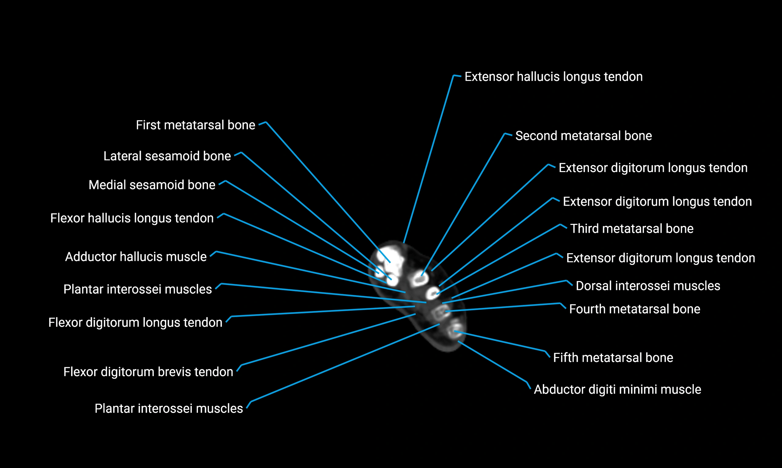CT lower limb axial cross sectional anatomy labelled image 192 (2).webp